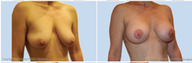 Breast Lift