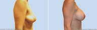 Breast Lift