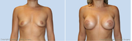 Breast Lift
