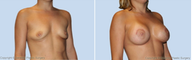 Breast Lift