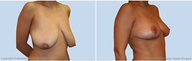Breast Lift