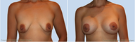 Breast Lift
