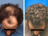 Hair Replacement