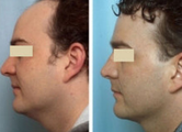 Fleming/Mayer flap