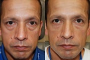 Lower eyelid and cheek rejuvenation with Silikon-1000
