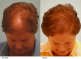 Female Hair Transplant