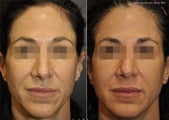 Sculptra