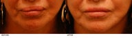 Lip Reduction