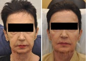 Cheek Augmentation