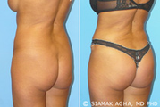 Brazilian Butt Lift