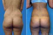 Brazilian Butt Lift