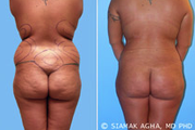 Brazilian Butt Lift