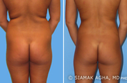 Brazilian Butt Lift