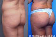 Brazilian Butt Lift