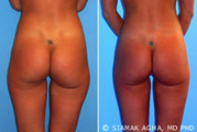 Brazilian Butt Lift