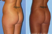 Brazilian Butt Lift