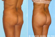 Brazilian Butt Lift