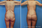 Brazilian Butt Lift