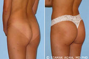 Brazilian Butt Lift