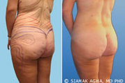 Brazilian Butt Lift