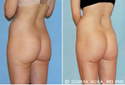 Brazilian Butt Lift