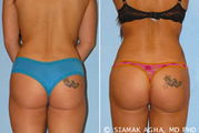 Brazilian Butt Lift