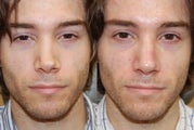 Non-Surgical Rhinoplasty with Silikon-1000 for permanent results.