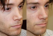 Non-Surgical Rhinoplasty with Silikon-1000 for permanent results.