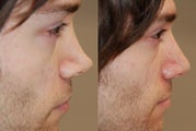 Non-Surgical Rhinoplasty with Silikon-1000 for permanent results.