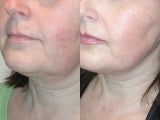 SLUPlift Neck & Jowl Lift