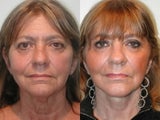 SLUPlift Neck & Jowl Lift & Submental Plication