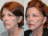 SLUPlift Neck & Jowl lift