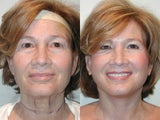 SLUPlift Neck & Jowl Lift