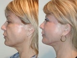 SLUPlift Neck & Jowl lift