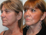 SLUPlift Neck & Jowl Lift & Submental Plication