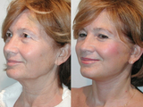 SLUPlift Neck & Jowl lift