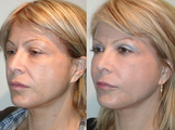 SLUPlift Neck & Jowl lift