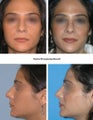 Septorhinoplasty Result