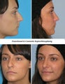 Septorhinoplasty