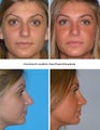 Rhinoplasty