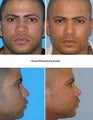 Rhinoplasty