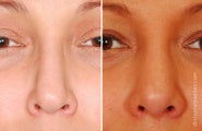 Revision Rhinoplasty
