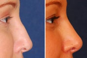 Revision Rhinoplasty