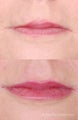 Restylane Lip Injection