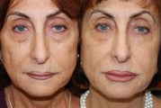 Non-Surgical Facial Rejuvenation with Silikon-1000