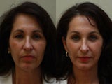 Brow Lift