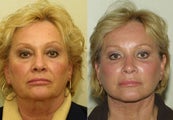 Neck Lift