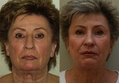 Neck Lift
