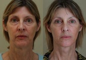 Neck Lift
