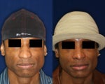Rhinoplasty and Nostril Narrowing